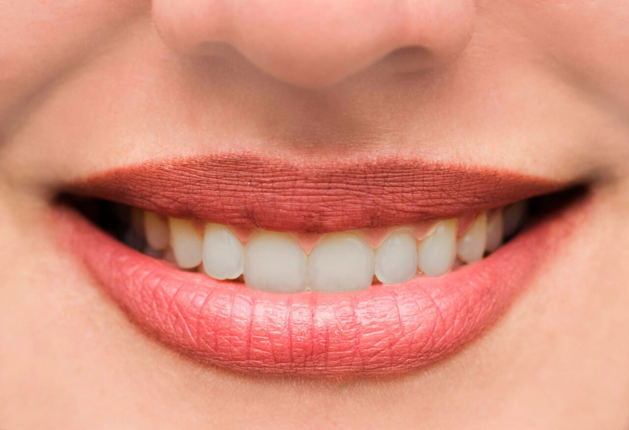 Patient teeth before dental treatment showing discoloration